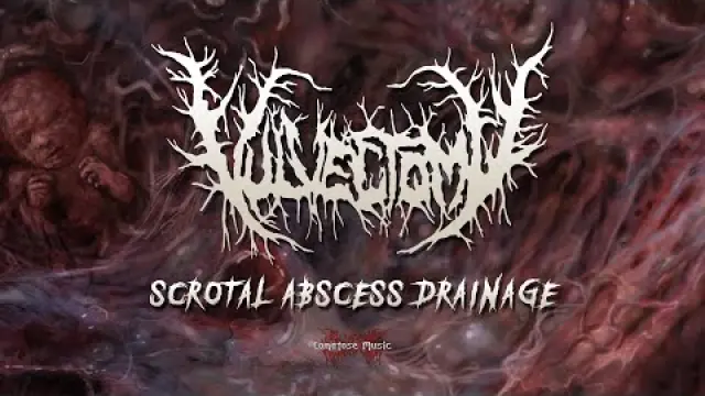 Scrotal Abscess Drainage